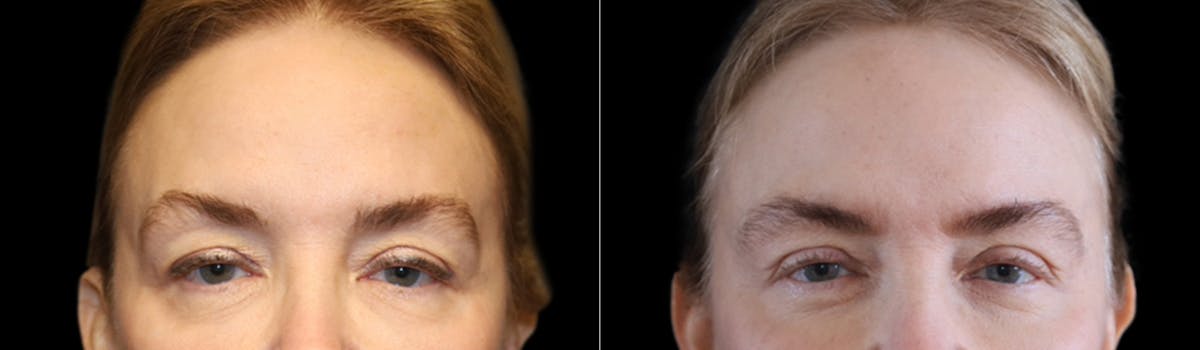 Blepharoplasty Before & After Gallery - Patient 424091 - Image 2