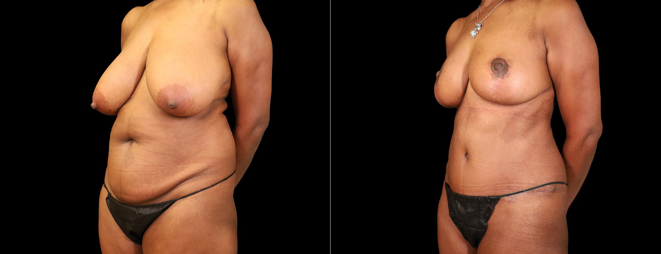 Breast Lift Before & After Gallery - Patient 338235 - Image 3