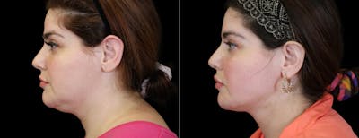 Neck Liposuction Before & After Gallery - Patient 260446 - Image 1