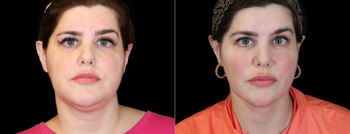 Neck Liposuction Before & After Gallery - Patient 260446 - Image 3
