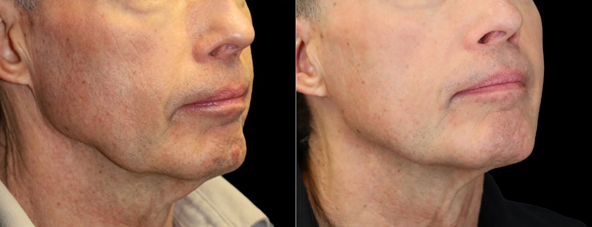 Sculptra Before & After Gallery - Patient 903162 - Image 2