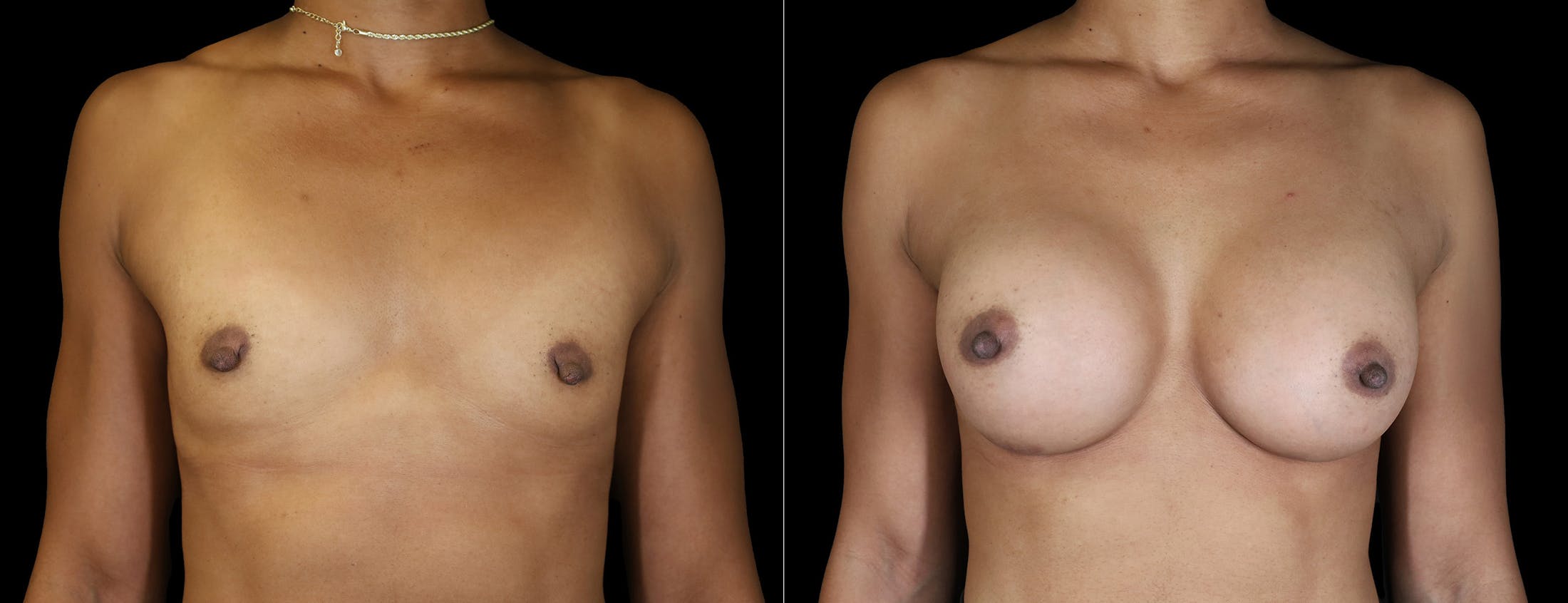 Breast Augmentation Before & After Gallery - Patient 242509 - Image 2
