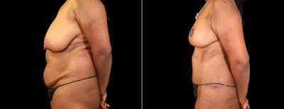 Breast Reduction Before & After Gallery - Patient 150517 - Image 2