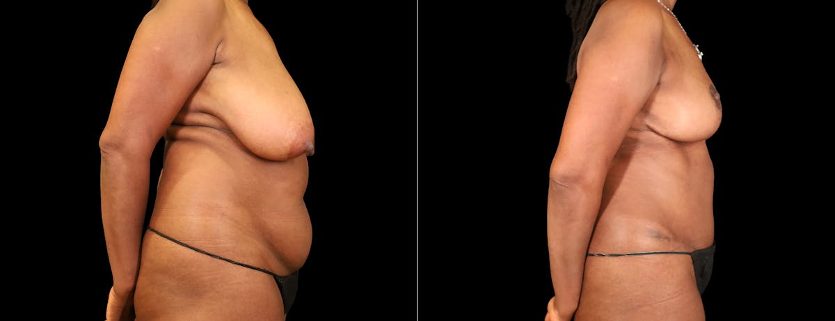 Abdominoplasty (Tummy Tuck) Before & After Gallery - Patient 205278 - Image 6