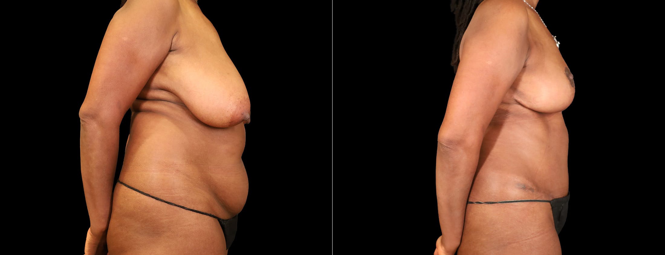Breast Lift Before & After Gallery - Patient 338235 - Image 6