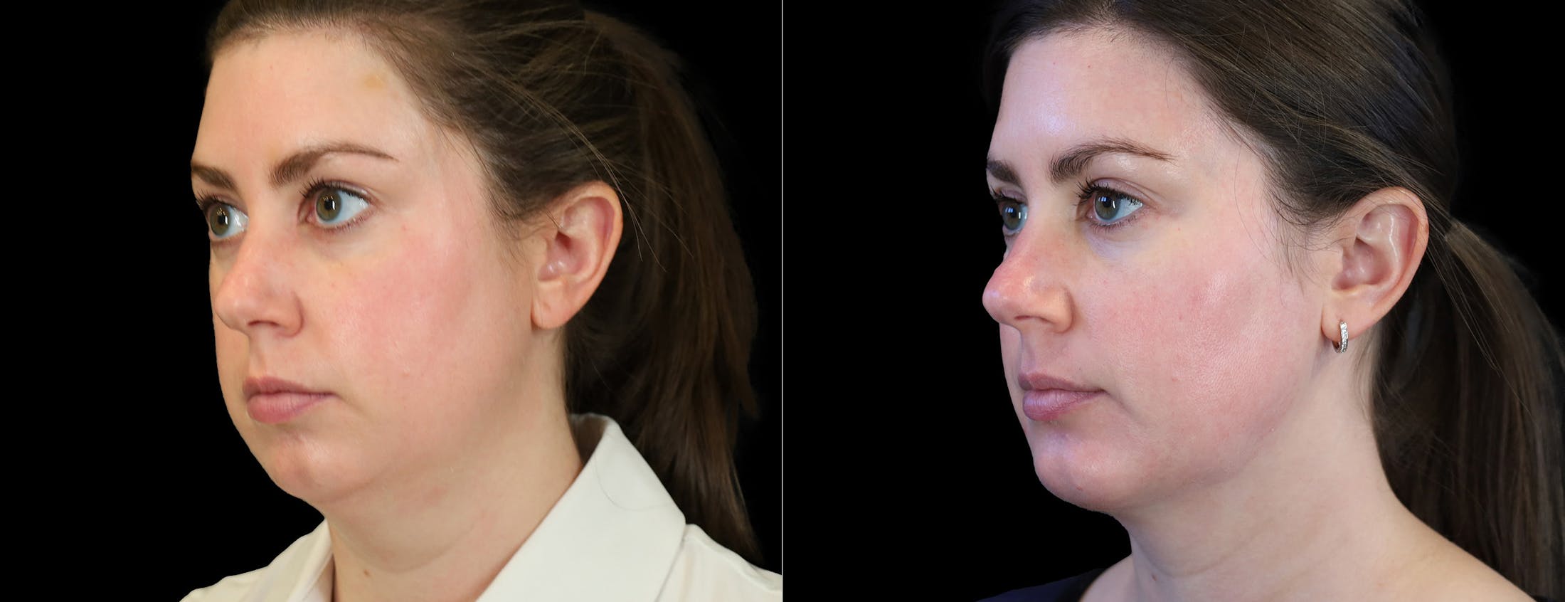 Chin Augmentation Before & After Gallery - Patient 261060 - Image 2