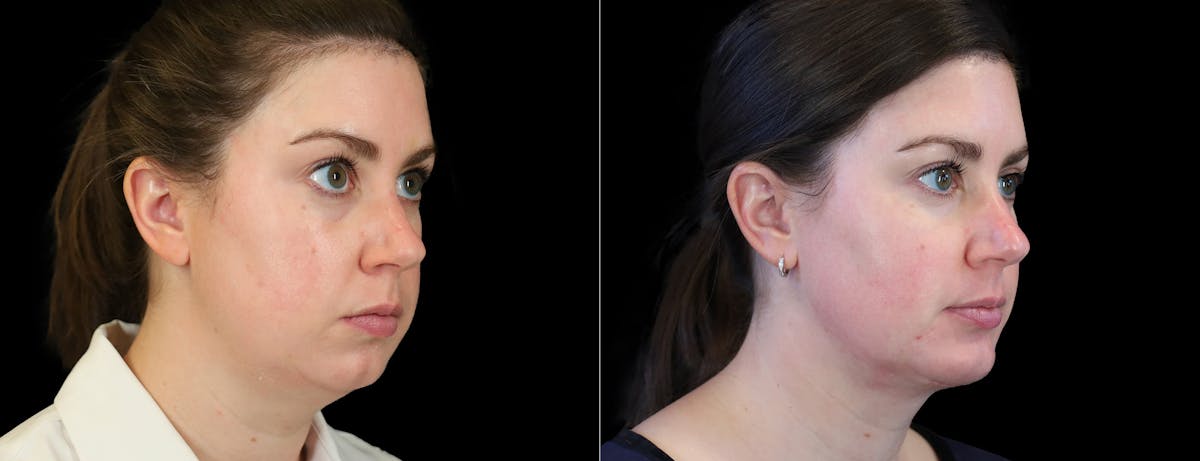 Fat Injections Before & After Gallery - Patient 196676 - Image 4