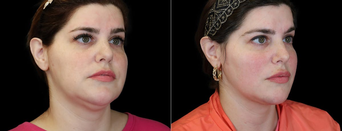 Neck Liposuction Before & After Gallery - Patient 260446 - Image 4