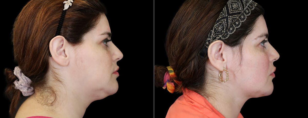 Neck Liposuction Before & After Gallery - Patient 260446 - Image 5