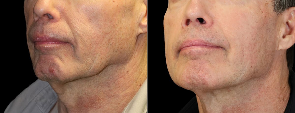 Sculptra Before & After Gallery - Patient 903162 - Image 1