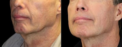 Sculptra Before & After Gallery - Patient 903162 - Image 1