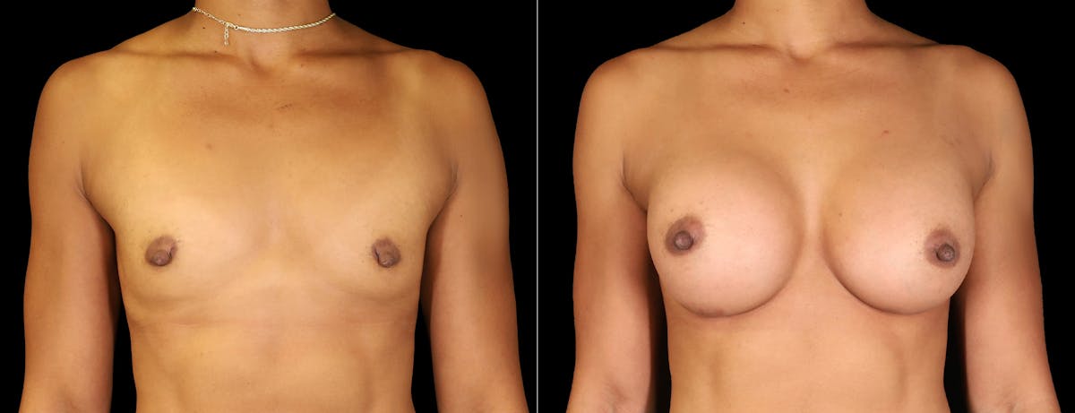 Breast Augmentation Before & After Gallery - Patient 242509 - Image 1