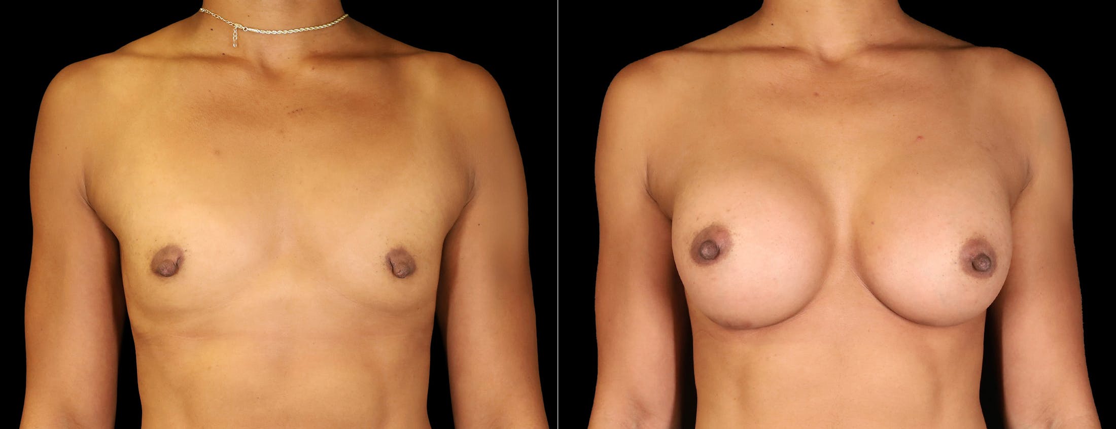 Breast Augmentation Before & After Gallery - Patient 242509 - Image 1