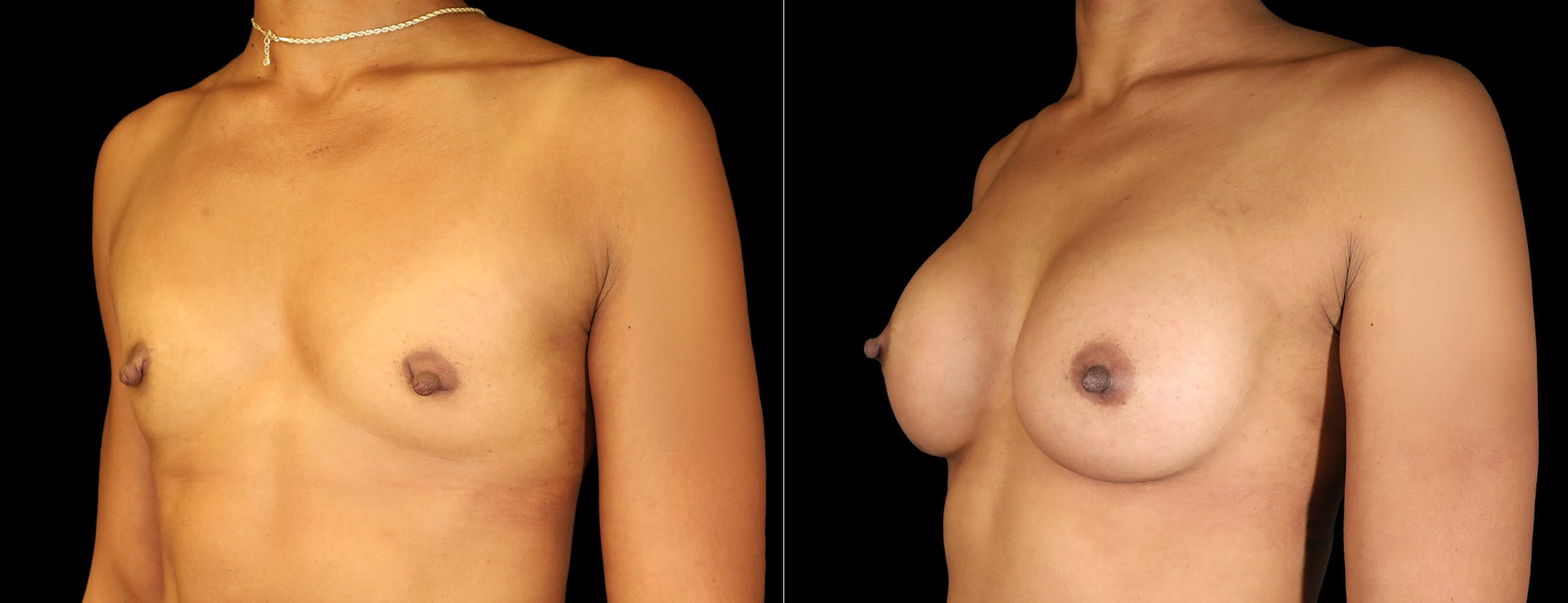 Breast Augmentation Before & After Gallery - Patient 242509 - Image 3