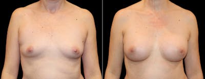 Breast Augmentation Before & After Gallery - Patient 401136 - Image 1