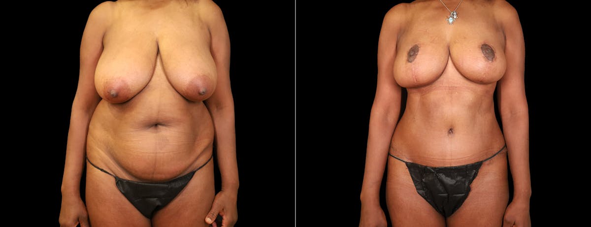 Abdominoplasty (Tummy Tuck) Before & After Gallery - Patient 205278 - Image 1