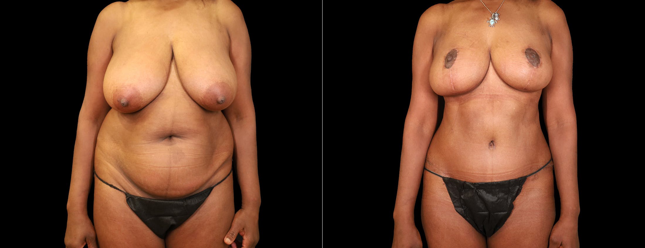 Breast Lift Before & After Gallery - Patient 338235 - Image 1