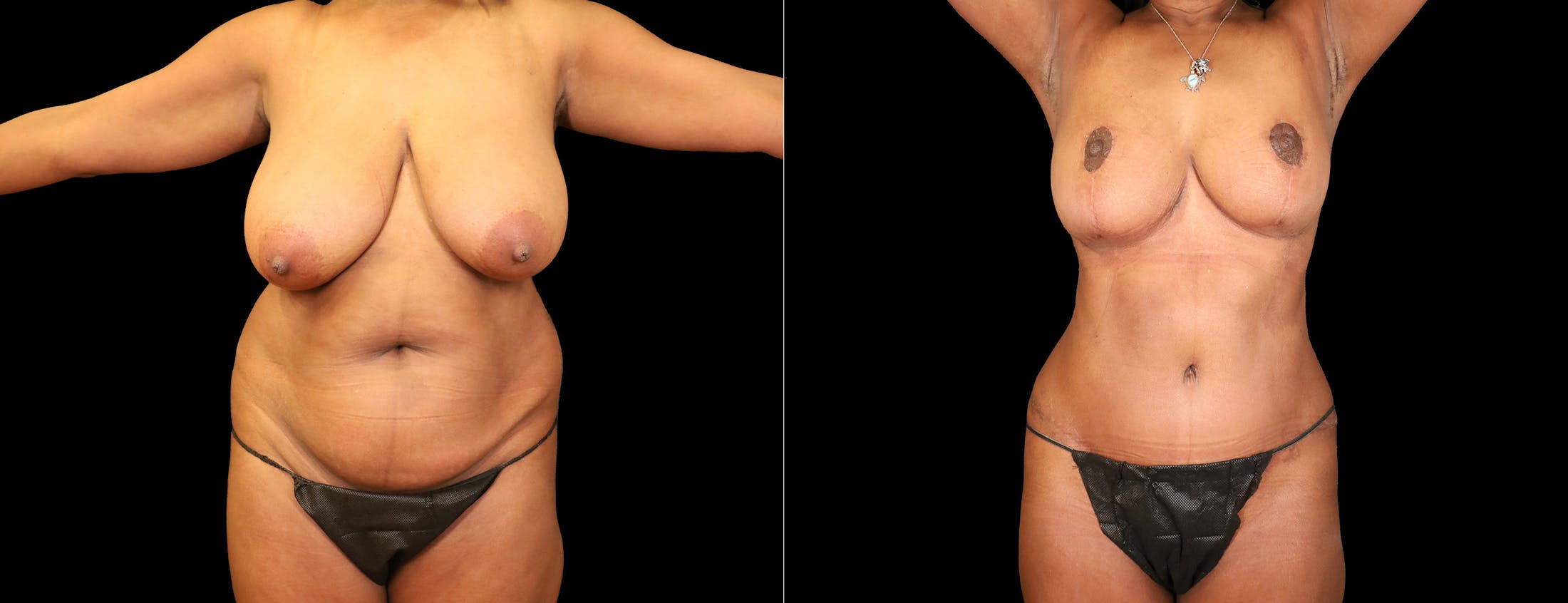 Breast Lift Before & After Gallery - Patient 338235 - Image 4