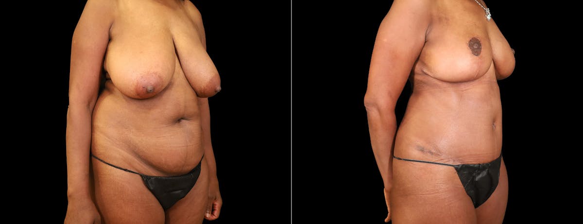 Abdominoplasty (Tummy Tuck) Before & After Gallery - Patient 205278 - Image 5