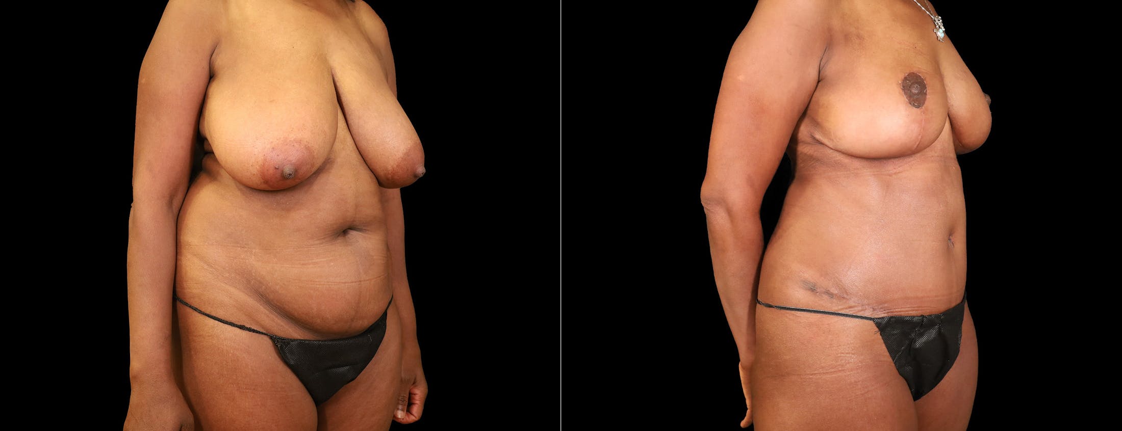 Breast Lift Before & After Gallery - Patient 338235 - Image 5