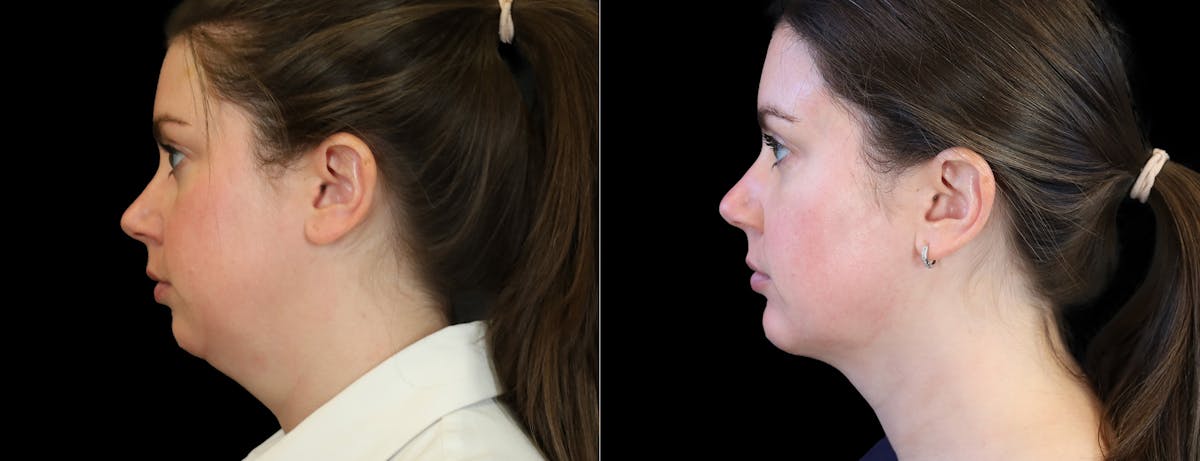 Fat Injections Before & After Gallery - Patient 196676 - Image 1
