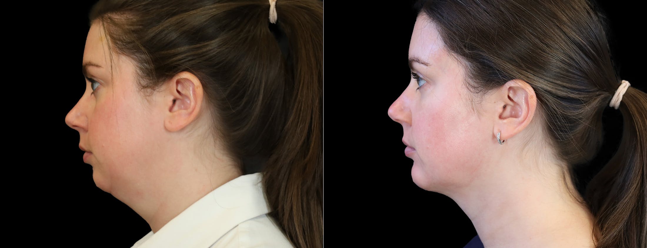 Chin Augmentation Before & After Gallery - Patient 261060 - Image 1