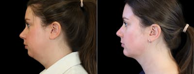 Chin Augmentation Before & After Gallery - Patient 261060 - Image 1