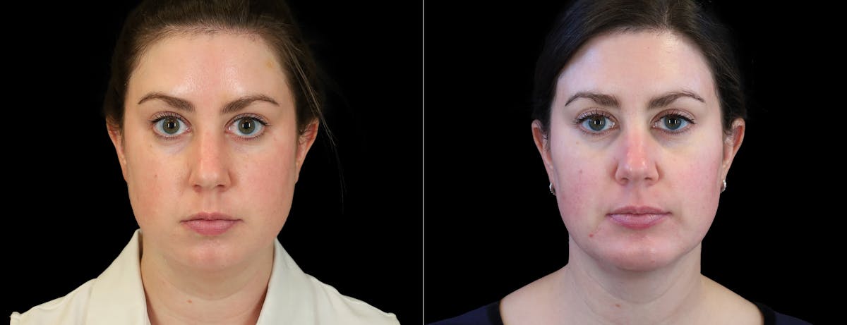 Fat Injections Before & After Gallery - Patient 196676 - Image 3