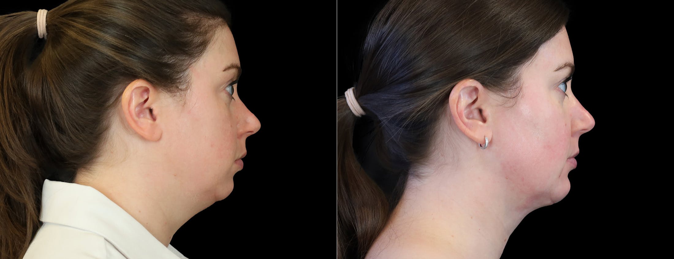 Chin Augmentation Before & After Gallery - Patient 261060 - Image 5