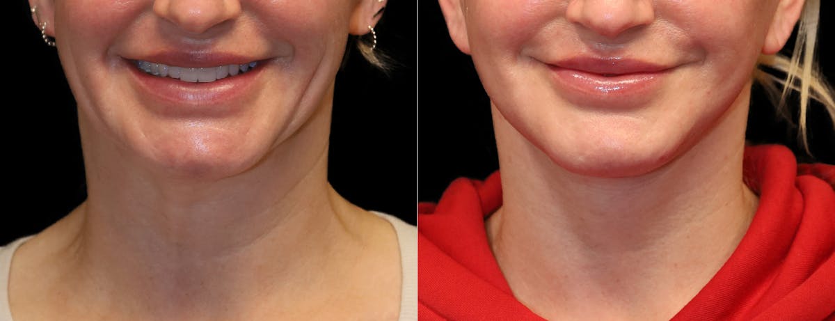 Neck Lift Before & After Gallery - Patient 949925 - Image 6