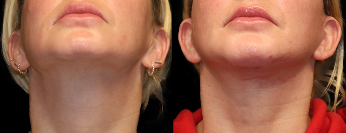 Neck Lift Before & After Gallery - Patient 949925 - Image 7