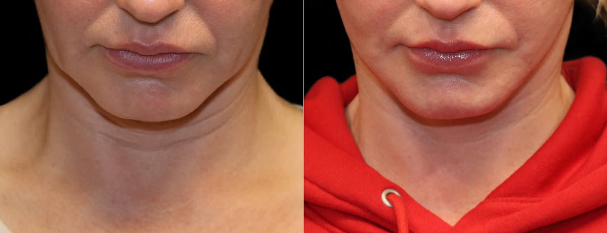 Neck Lift Before & After Gallery - Patient 949925 - Image 8