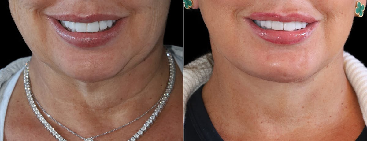 Deep Plane Facelift Before & After Gallery - Patient 347867 - Image 6