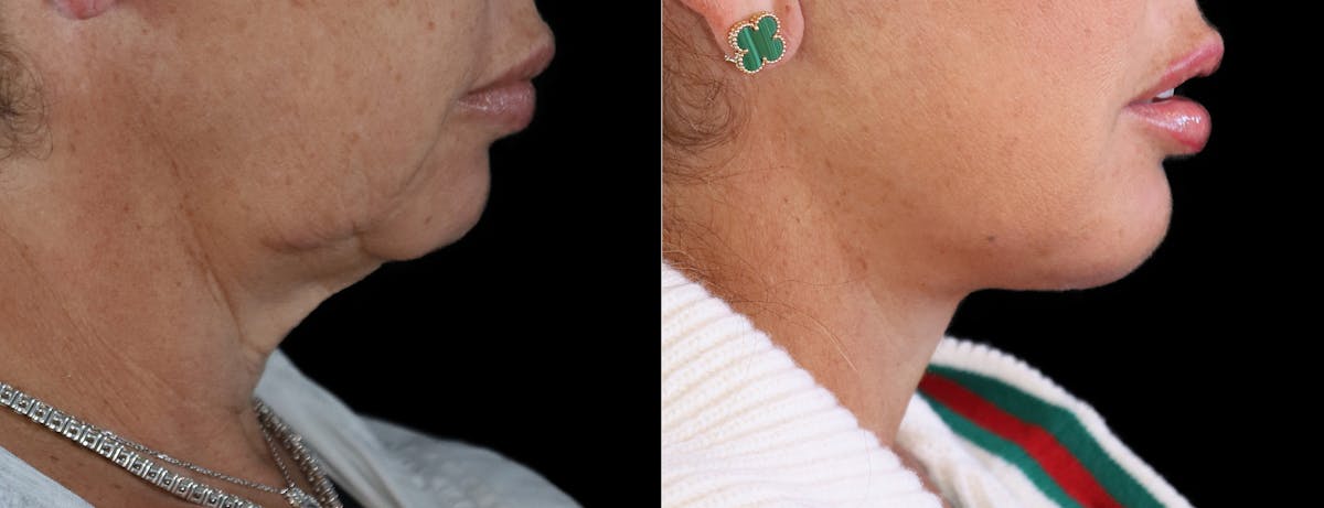 Deep Plane Facelift Before & After Gallery - Patient 347867 - Image 8