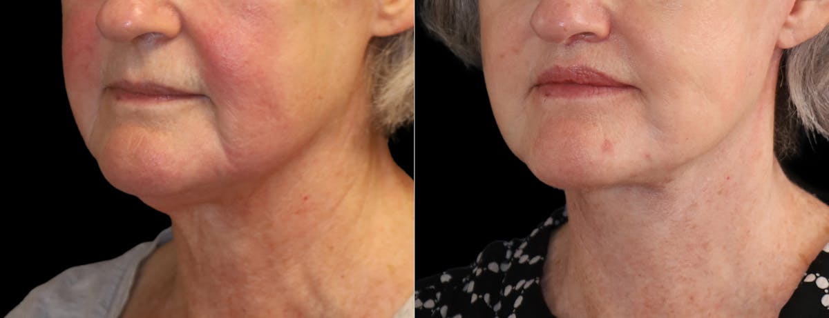 Neck Lift Before & After Gallery - Patient 215457 - Image 3