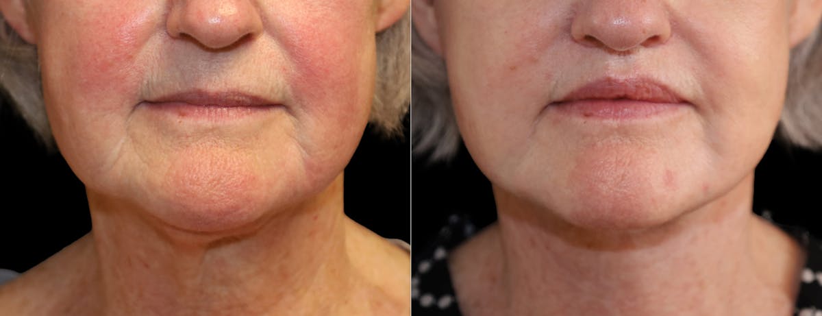 Neck Lift Before & After Gallery - Patient 215457 - Image 6