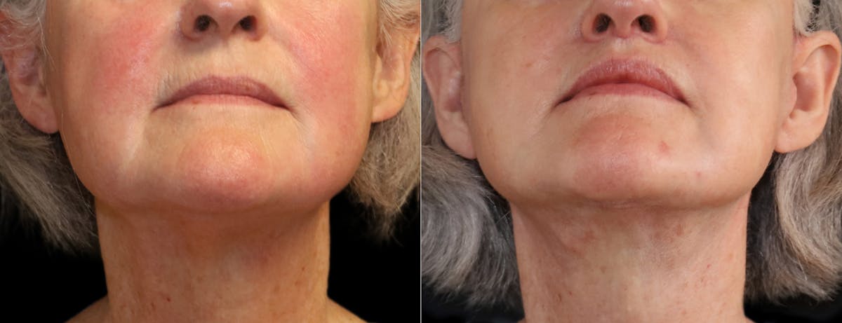 Neck Lift Before & After Gallery - Patient 215457 - Image 8