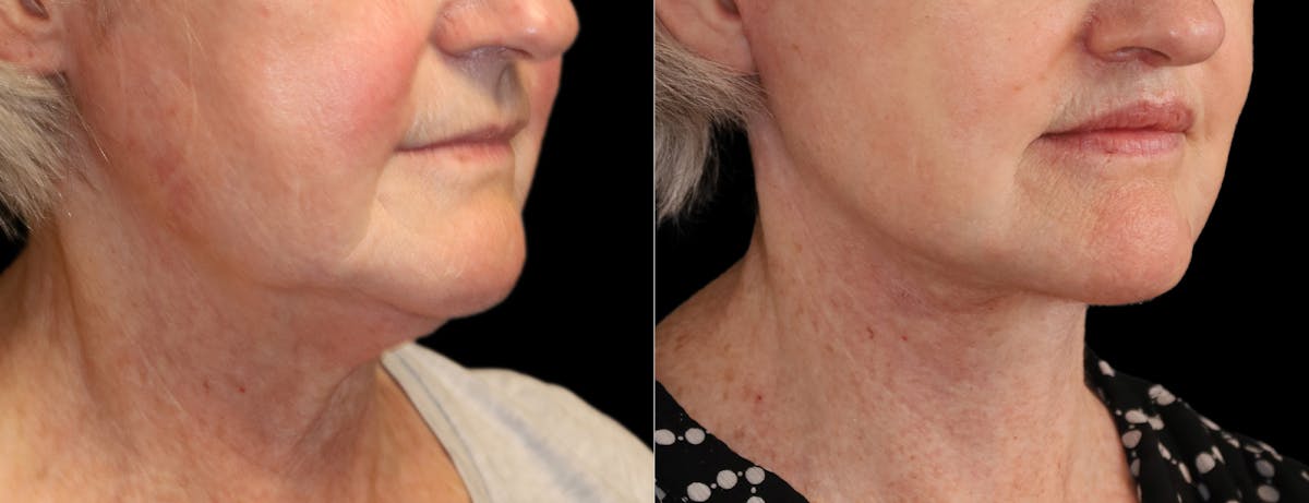Neck Lift Before & After Gallery - Patient 215457 - Image 10