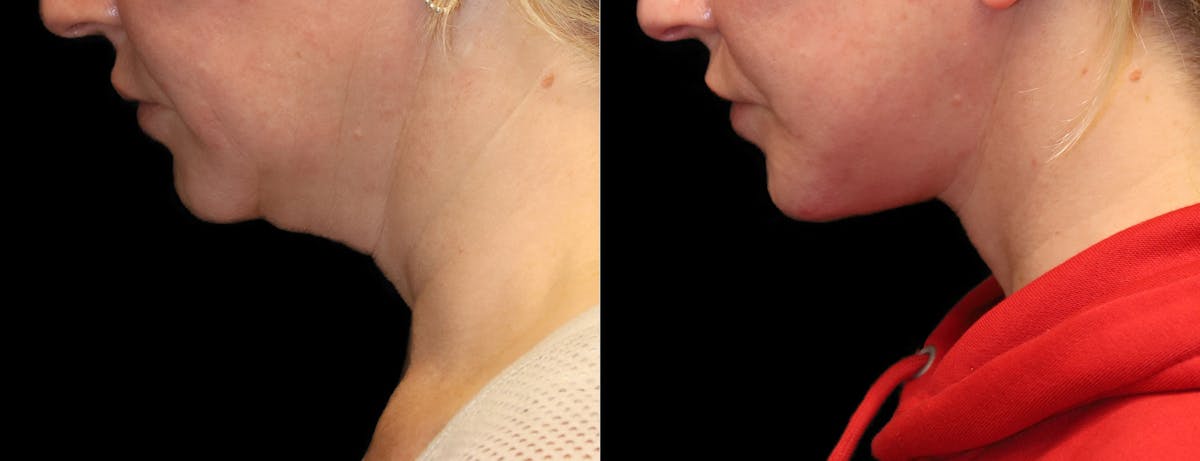 Neck Lift Before & After Gallery - Patient 949925 - Image 2