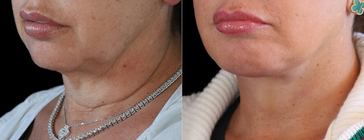 Deep Plane Facelift Before & After Gallery - Patient 347867 - Image 4