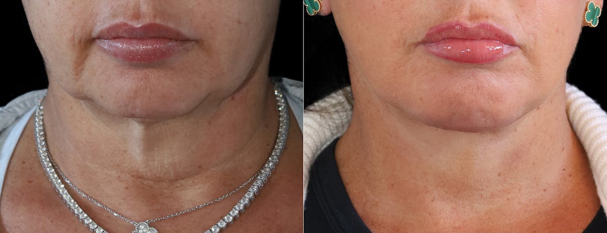 Deep Plane Facelift Before & After Gallery - Patient 347867 - Image 5