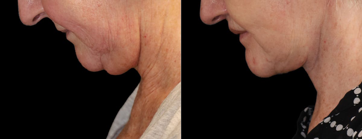 Neck Lift Before & After Gallery - Patient 215457 - Image 2