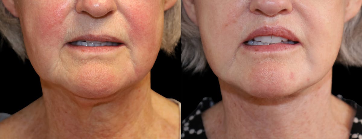 Neck Lift Before & After Gallery - Patient 215457 - Image 7