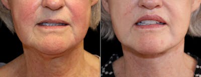 Deep Plane Facelift Before & After Gallery - Patient 348049 - Image 1