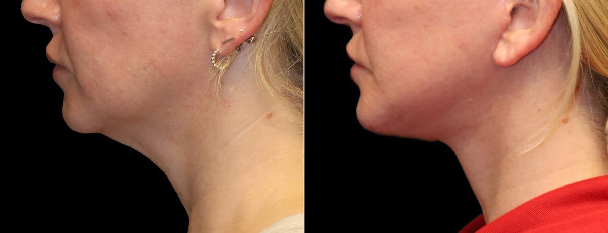 Neck Lift Before & After Gallery - Patient 949925 - Image 1