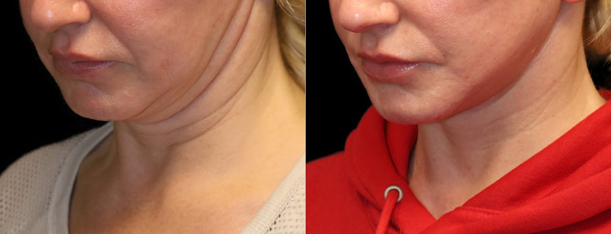 Neck Lift Before & After Gallery - Patient 949925 - Image 4