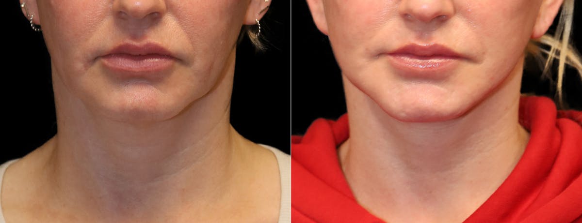 Neck Lift Before & After Gallery - Patient 949925 - Image 5