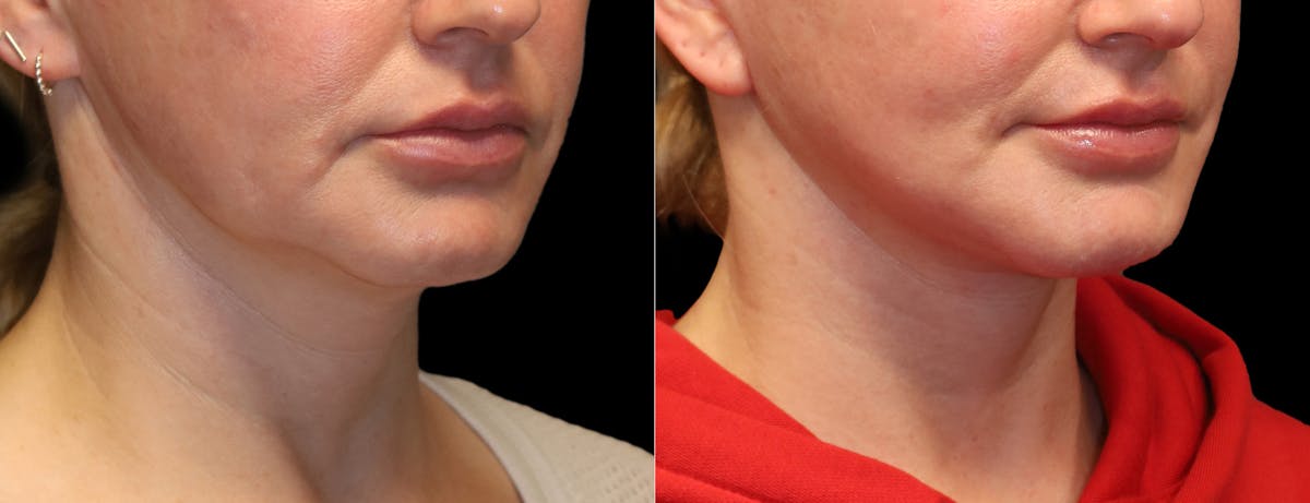 Neck Lift Before & After Gallery - Patient 949925 - Image 10
