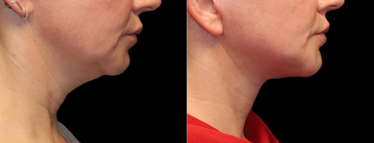 Neck Lift Before & After Gallery - Patient 949925 - Image 11