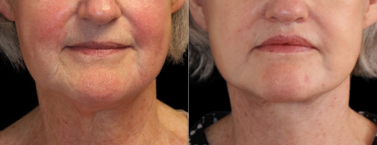 Neck Lift Before & After Gallery - Patient 215457 - Image 4